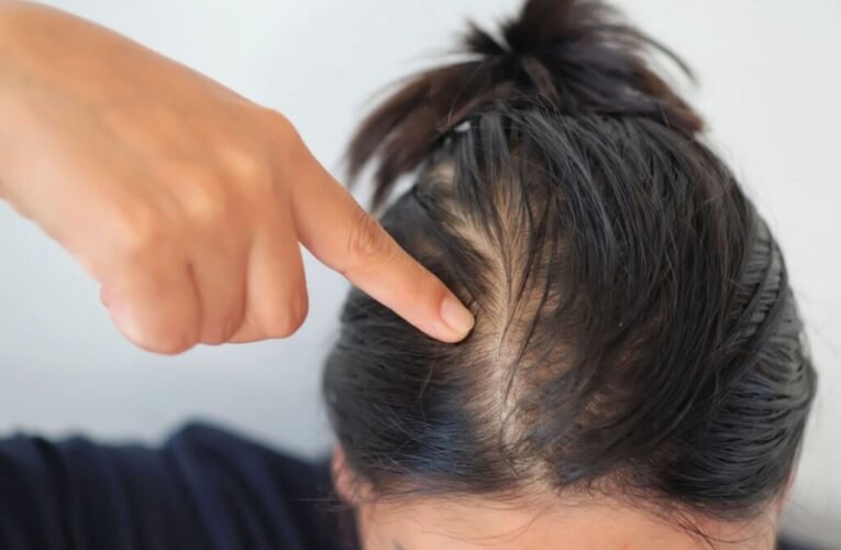 Natural Ways to Regrow Thinning Hair