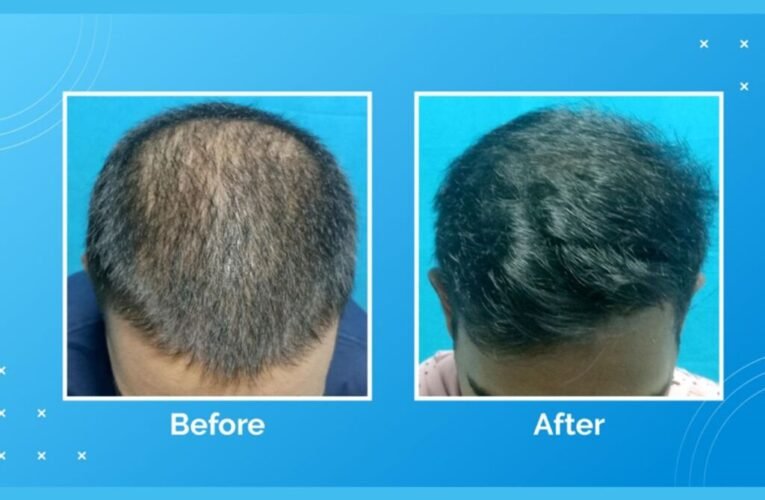 Vcare’s Treatment For Hair Loss And Hair Thinning