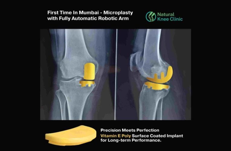 Medical Breakthrough: Preserve Your Natural Knee with Absolute Precision Robotic Microplasty Surgical Technique